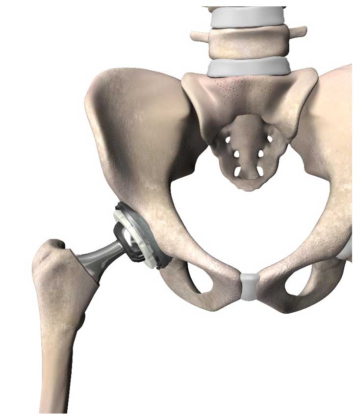 Total Hip Replacement (Anterior) - Dr. Armin Arshi, Hip and Knee ...